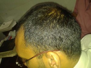Alopecia Areata After treatment at Dr SHAH's Homoeopathy by Dr Deepan P Shah