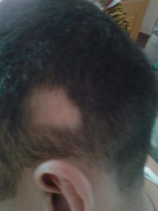 Alopecia Areata Before treatment at Dr SHAH's Homoeopathy