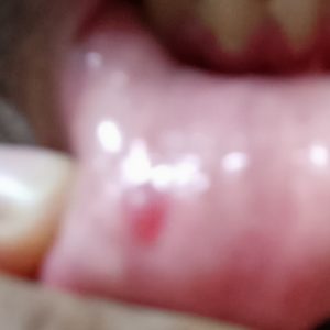 Oral Mucocele, Mucous Retention Cyst, Mucous Extravasation Phemenon