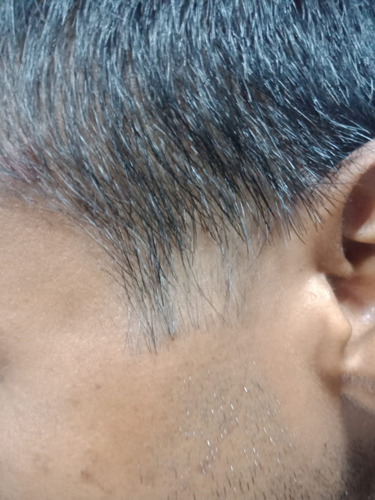 Alopecia Areata Before Homeopathic Treatment