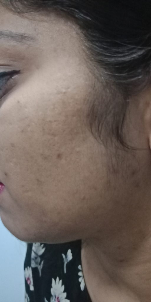 ACNE CURED AFTER HOMEOPATHIC TREATMENT AT Dr SHAH's HOMOEOPATHY