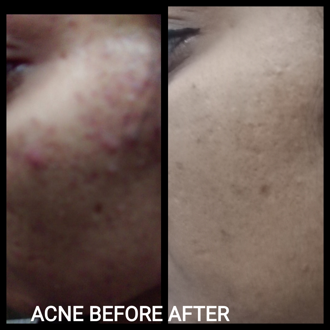 Acne Homeopathic Treatment approach, Homeopathic Medicines