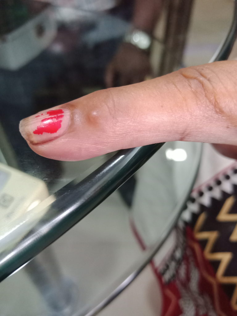 Rheumatic Nodule of Skin in patient with Rheumatoid Arthritis
