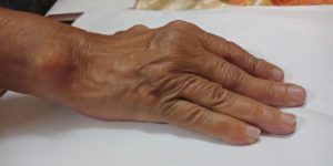 Multiple Necrotising Granomatous Nodules of Rheumatoid Arthritis