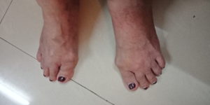 Disfigurement of Toes in Rheumatoid Arthritis