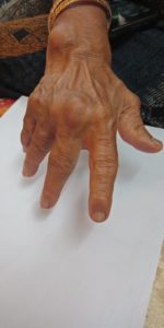 with Ulnar Deviation of fingers in Rheumatoid Arthritis