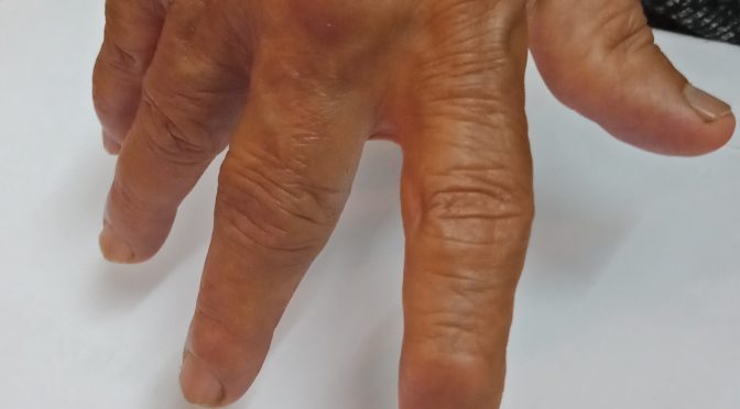 Fájó ízületek kezelése nem járhat Reumatoid Artritis - Fájdalomközpont