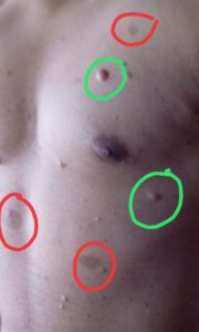 Cafe au Lait spots and neurofibroma in patient with Neurofibromatosis. 1)Neurofibroma marked in Green Circles 2)Cafe au Lait spots marked in Red Circles